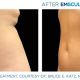 NeoSculpt Results - Woman Ab