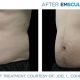 NeoSculpt Results - man Ab