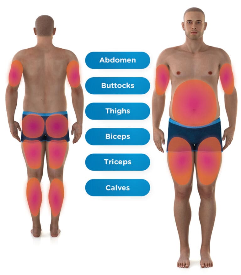 EMSculpt Treatment Zones man