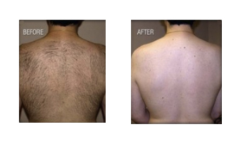 Back hair before and after laser hair removal