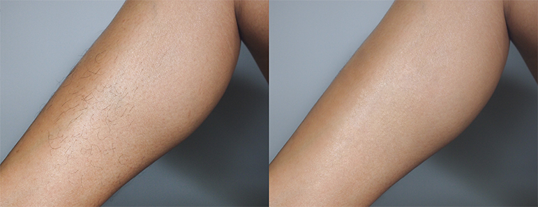 Legs before and after laser hair removal